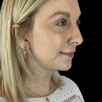 after-deep-plane-facelift-necklift